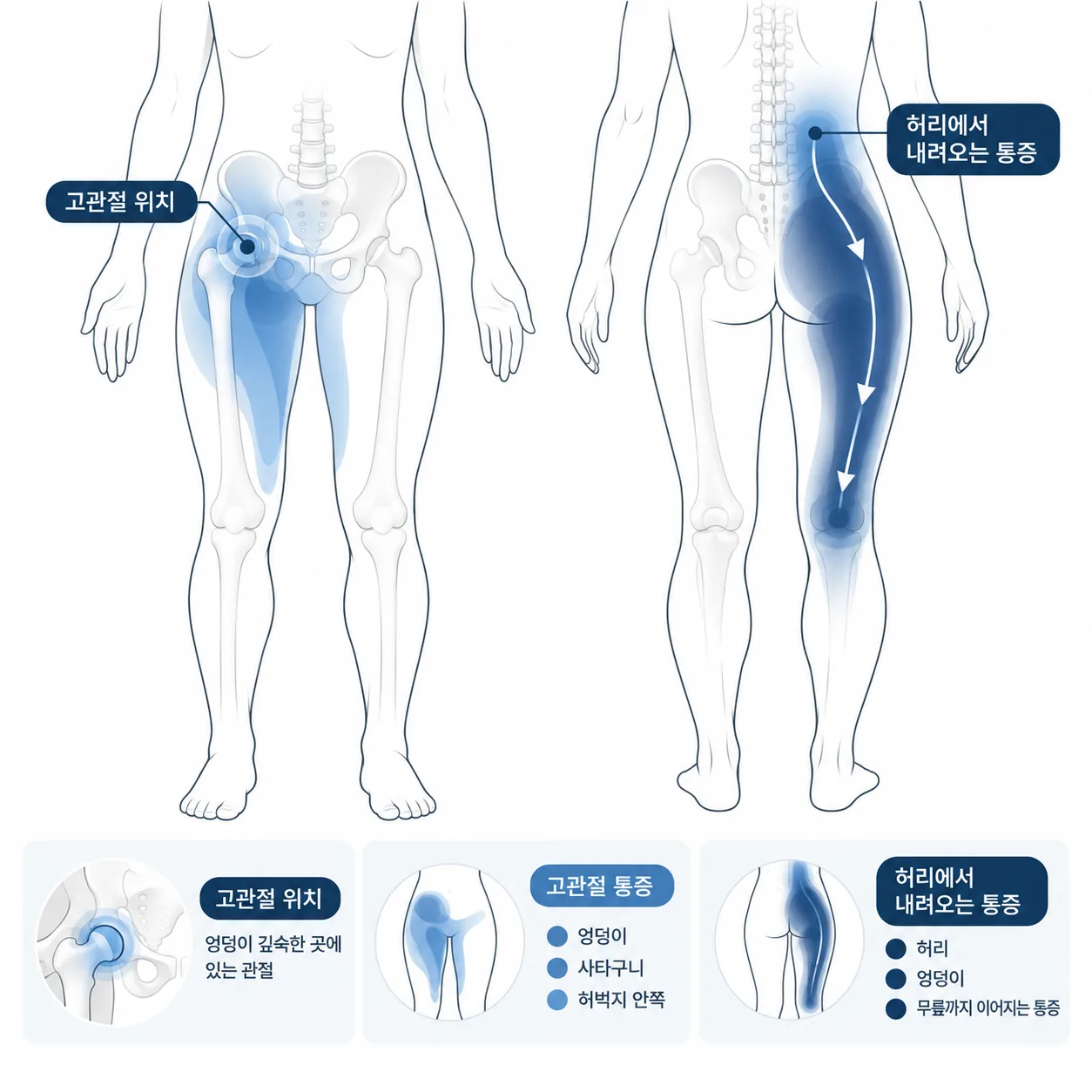 고관절 위치와 고관절 통증 범위, 허리에서 내려오는 통증 범위를 두 색으로 구분한 개념도