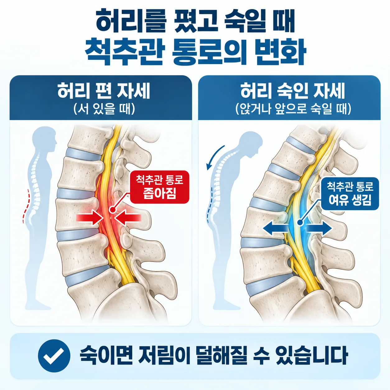 허리를 폈을 때와 숙였을 때 신경이 지나는 척추관 통로의 넓이를 비교한 개념도