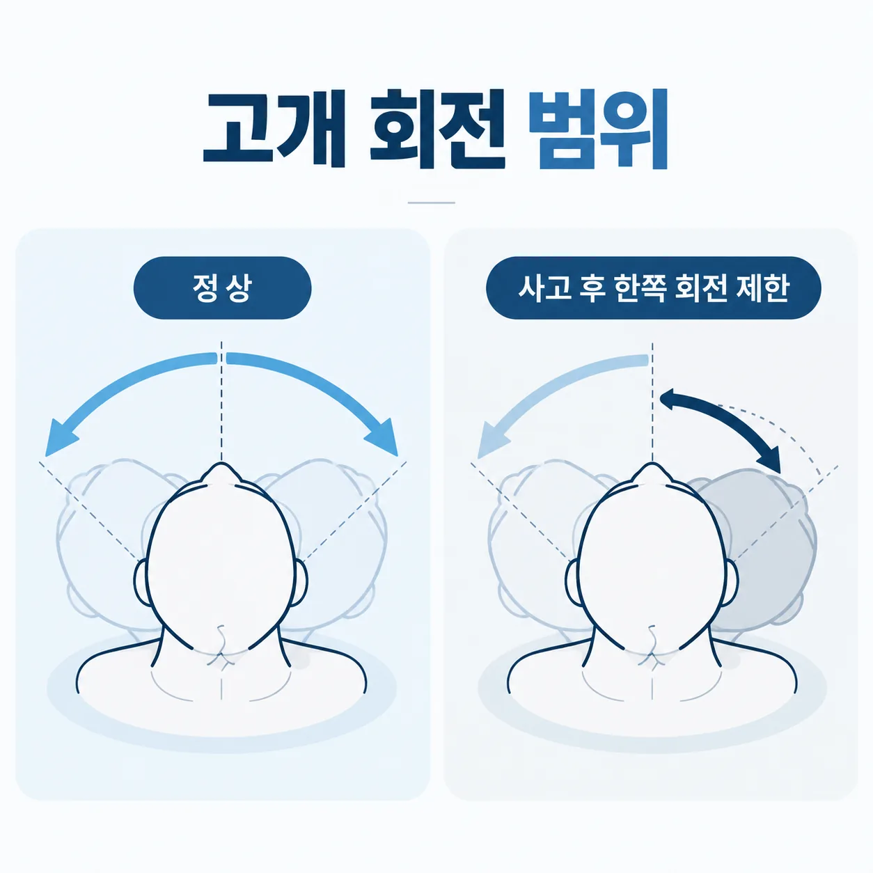 교통사고 뒤 고개를 한쪽으로 돌리는 범위가 줄어든 모습을 비교한 개념도