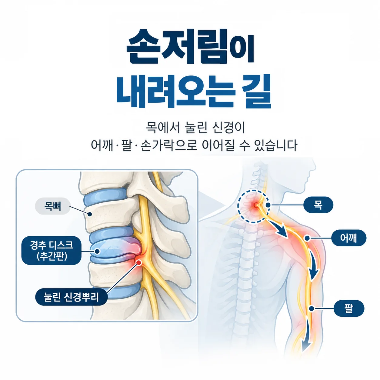목디스크로 눌린 신경에서 팔과 손가락으로 저림이 내려가는 길을 그린 개념도
